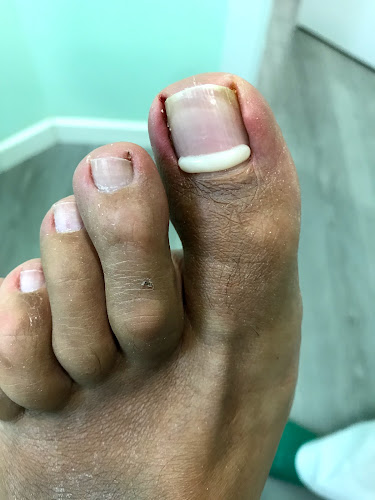 Podología Deportiva Clínica del pie SÁNCHEZ DOBLADO Madrid.